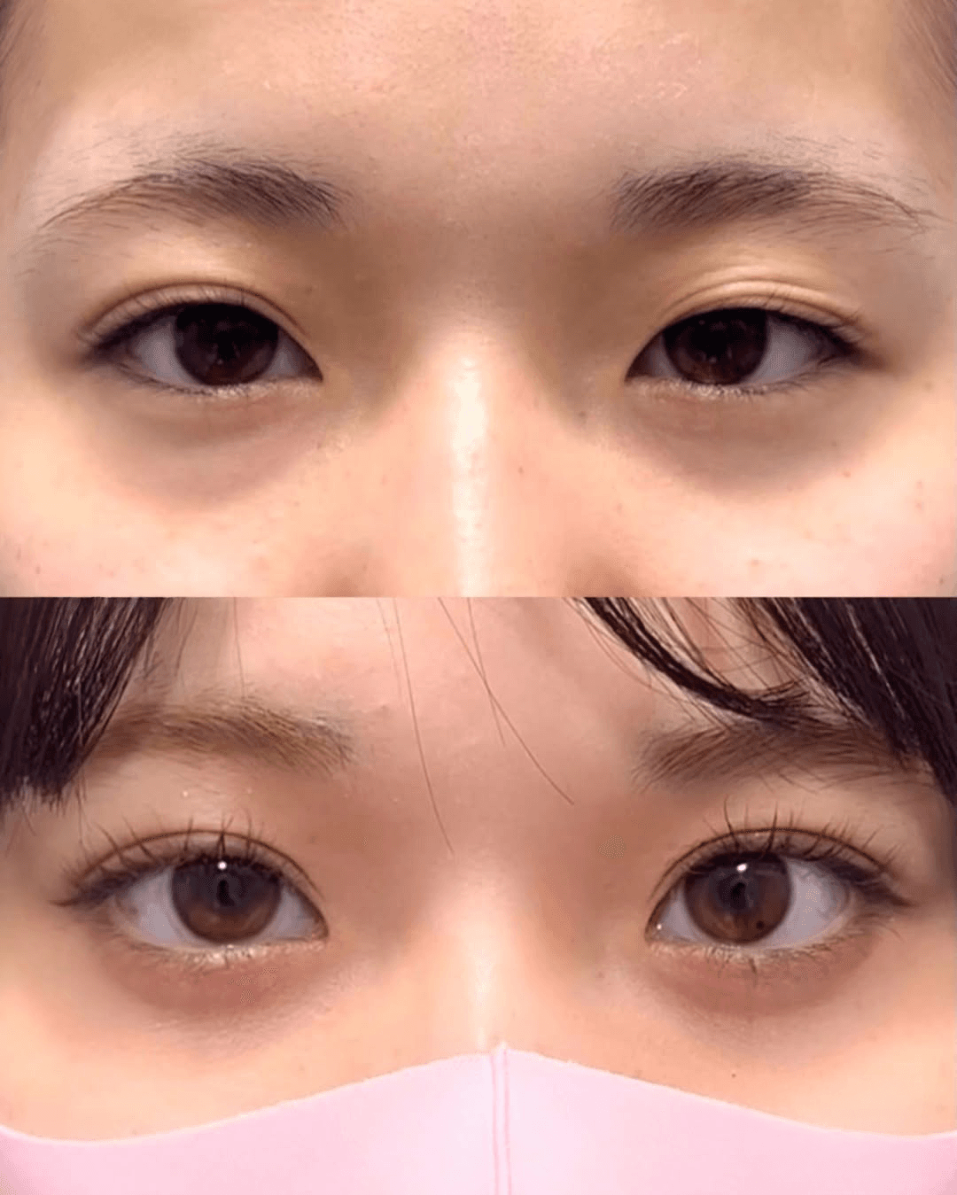 Double eyelid case 2 before and after