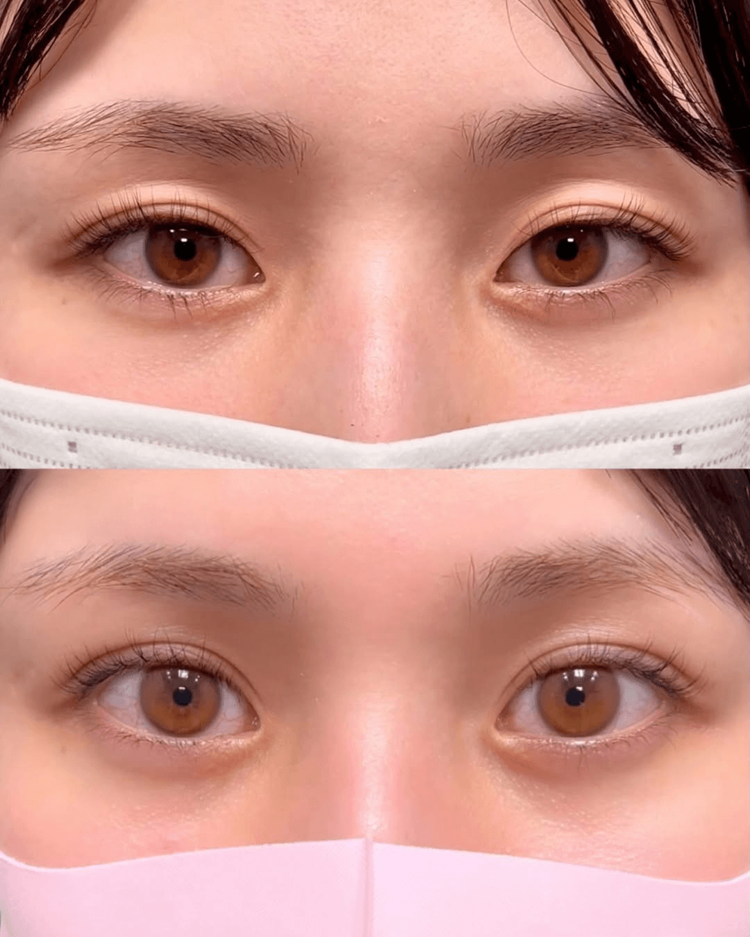 Double eyelid case 3 before and after
