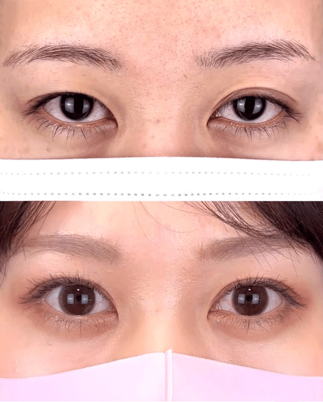 Double eyelid case 4 before and after